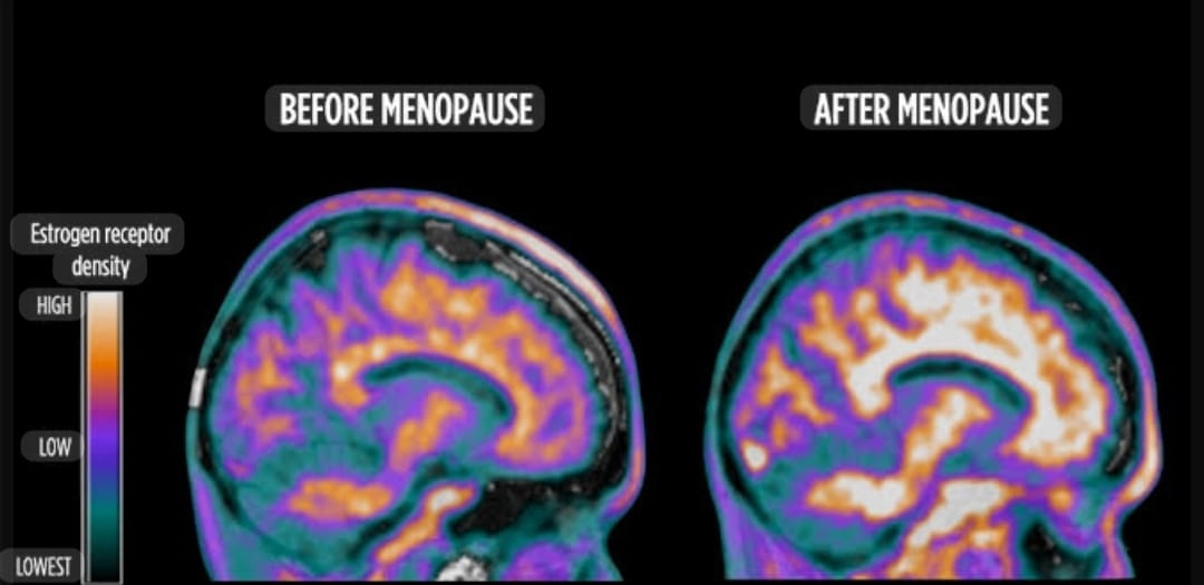 What Science Is Telling Us About Perimenopause, Menopause, the Brain, and Hormones